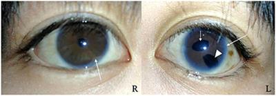 Case report: Congenital mitral and tricuspid valve insufficiency in a patient with Axenfeld-Rieger syndrome